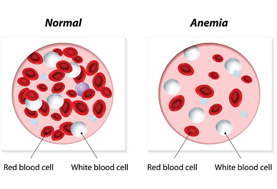 Hasil gambar untuk anemia