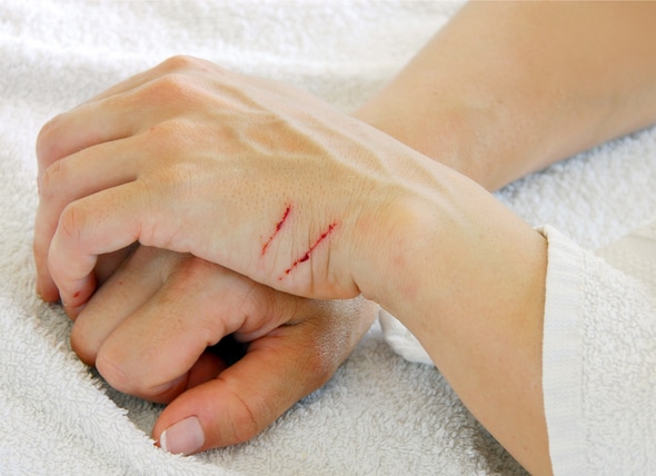 How to Treat Cat Scratches at Home