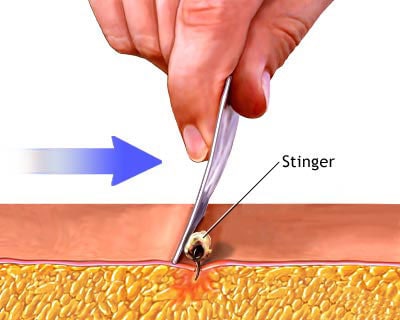 bee sting, remove a stinger